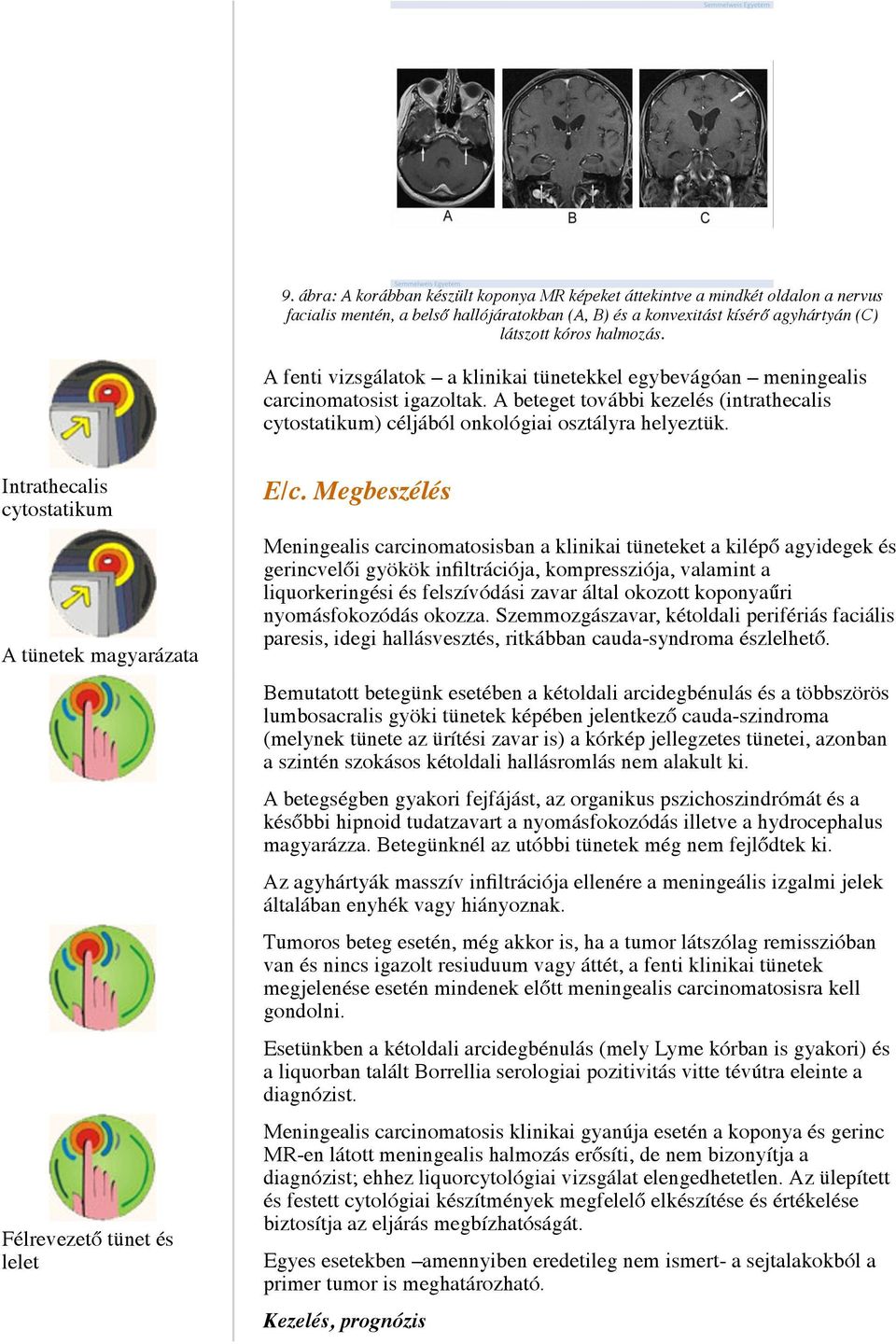 Intrathecalis cytostatikum A tünetek magyarázata Félrevezető tünet és lelet E/c.