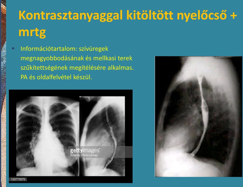 megnagyobbodásának és mellkasi terek