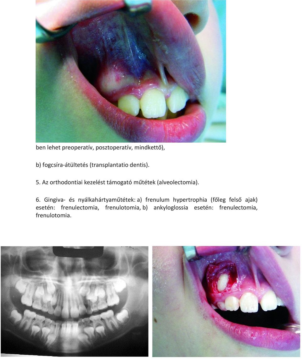 Az orthodontiai kezelést támogató műtétek (alveolectomia). 6.