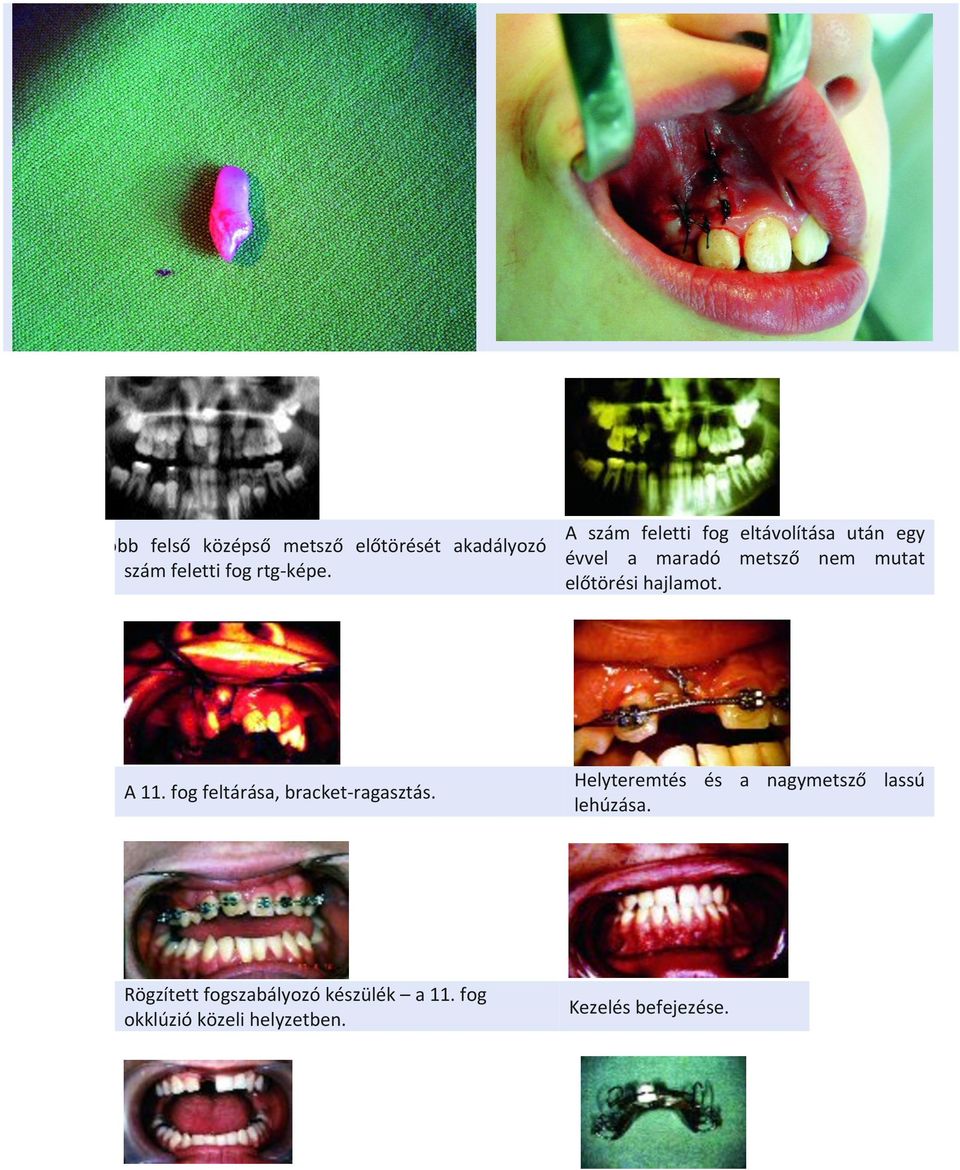 hajlamot. A 11. fog feltárása, bracket- ragasztás.