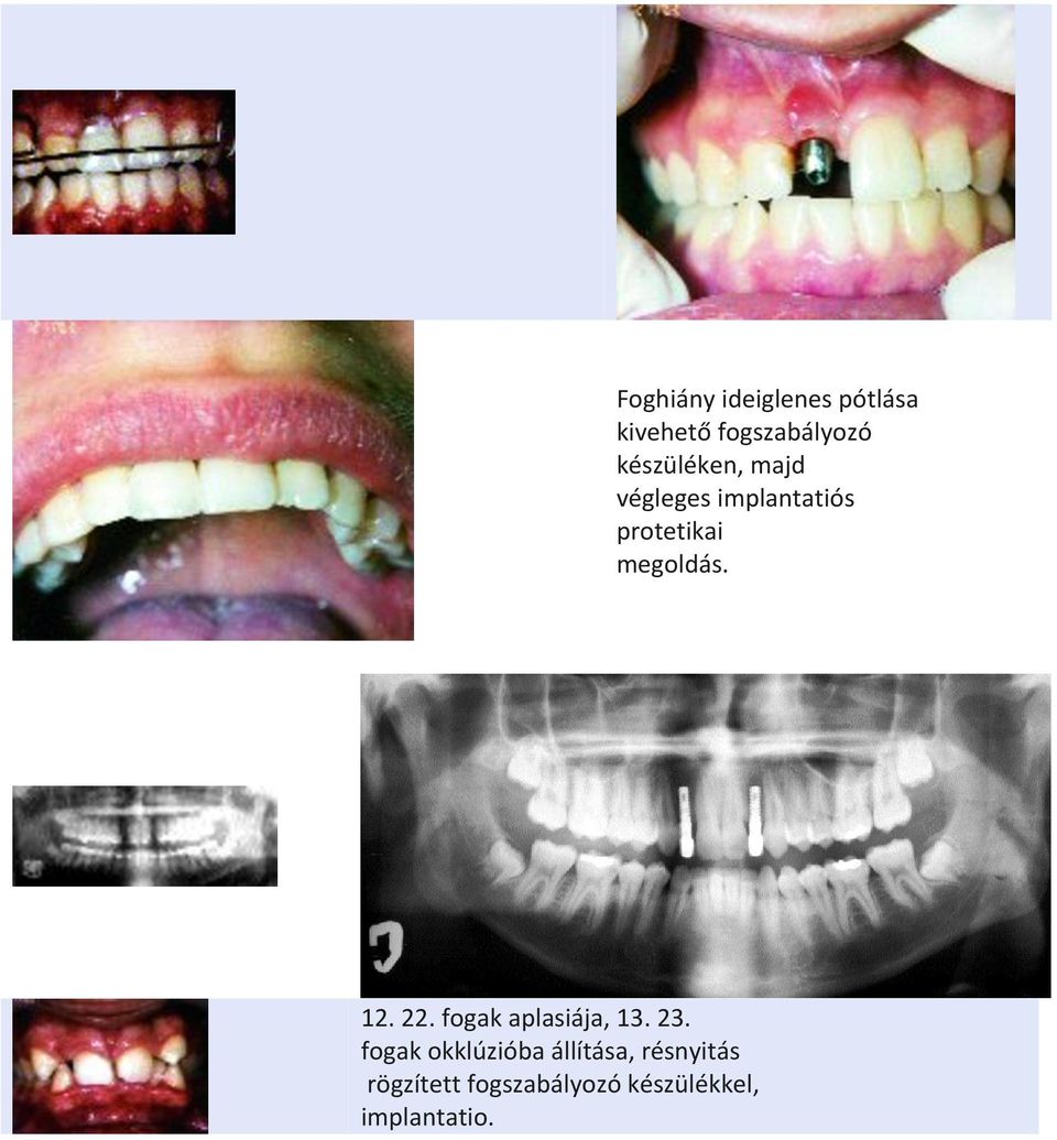 megoldás. 12. 22. fogak aplasiája, 13. 23.