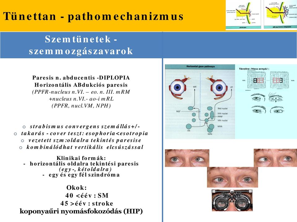 vm, NPH) strabismus cnvergens szemállás+/- takarás - cver teszt: esphria<estrpia vezetett szm:ldalra tekintés paresise