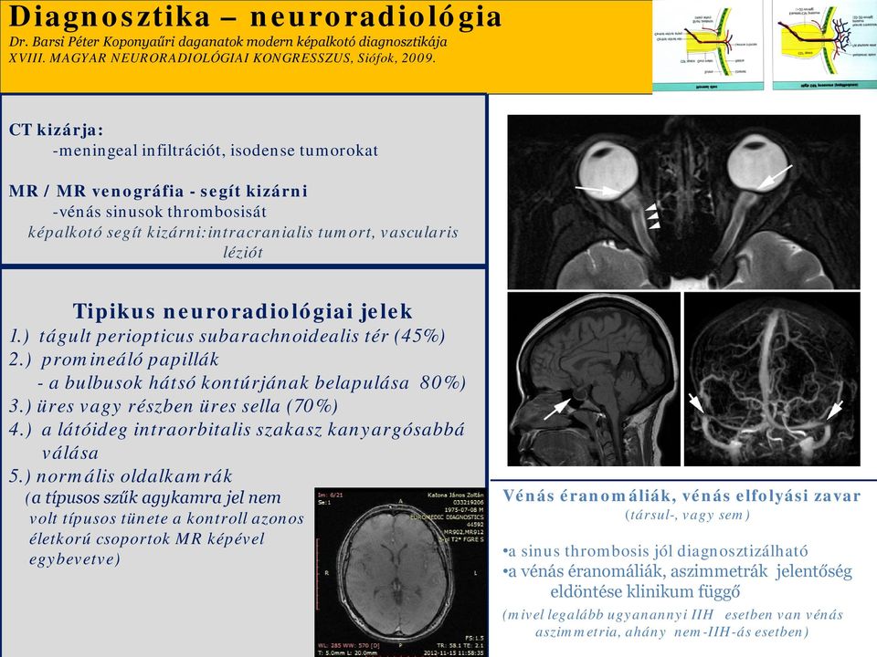 jelek 1.) tágult peripticus subarachnidealis tér (45%) 2.) prmineáló papillák - a bulbusk hátsó kntúrjának belapulása 80%) 3.) üres vagy részben üres sella (70%) 4.