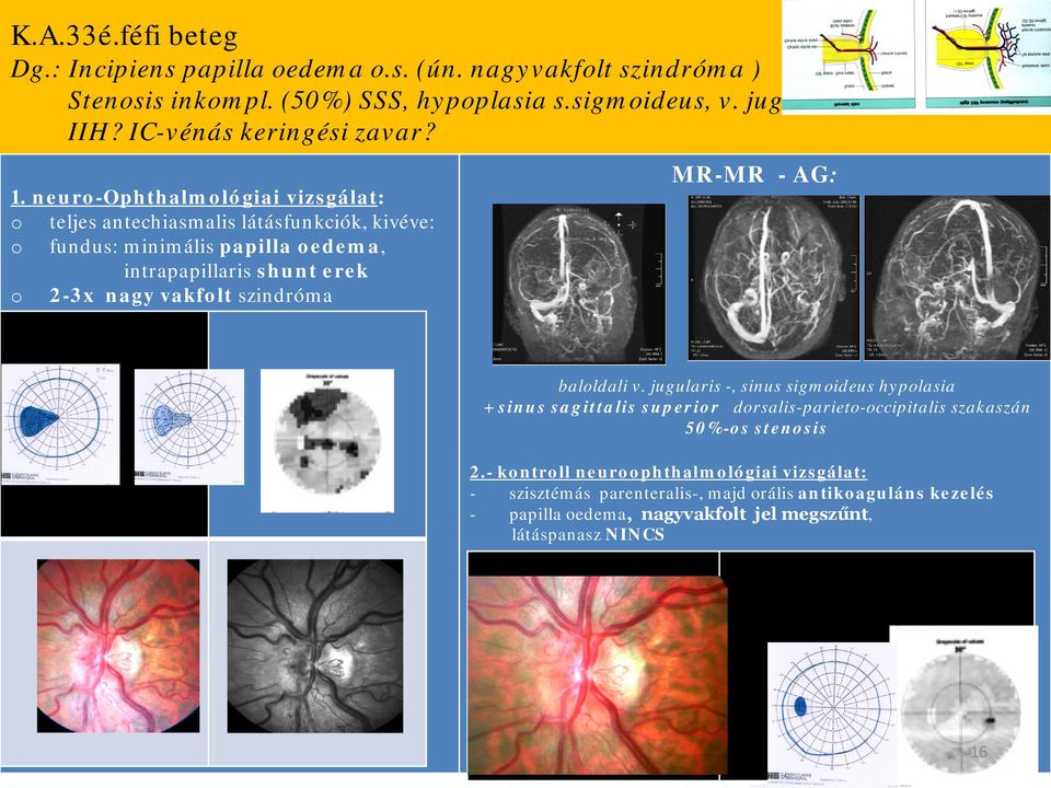 neur-ophthalmlógiai vizsgálat: teljes antechiasmalis látásfunkciók, kivéve: fundus: minimális papilla edema, intrapapillaris shunt erek 2-3x nagy vakflt