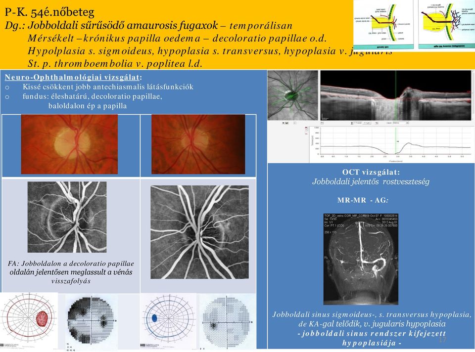 Neur-Ophthalmlógiai vizsgálat: Kissé csökkent jbb antechiasmalis látásfunkciók fundus: éleshatárú, declrati papillae, balldaln ép a papilla OCT vizsgálat: Jbbldali