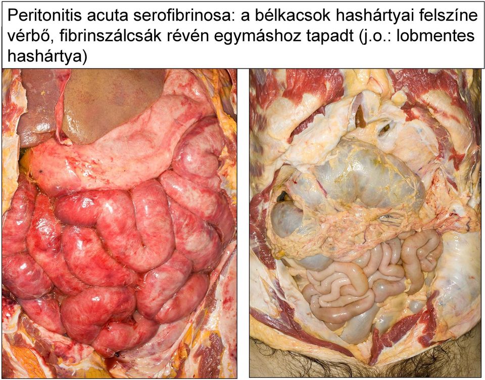 vérbő, fibrinszálcsák révén