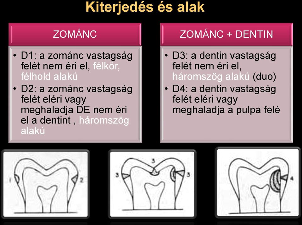 dentint, háromszög alakú ZOMÁNC + DENTIN D3: a dentin vastagság felét nem éri