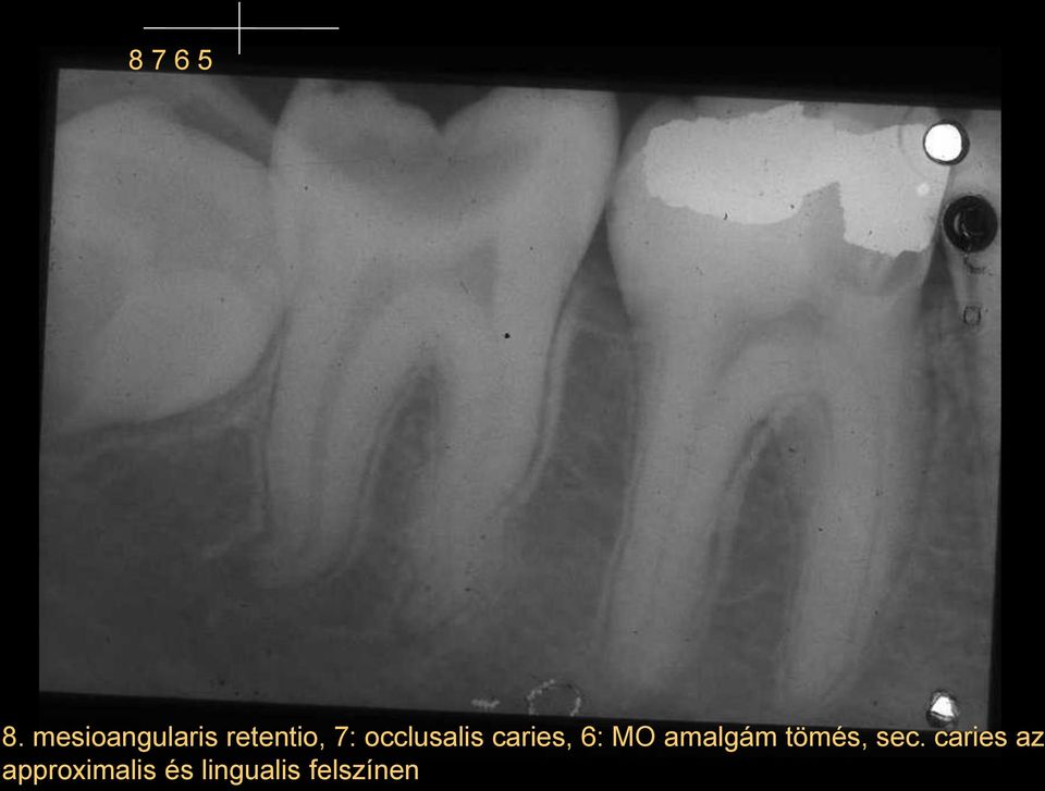 occlusalis caries, 6: MO amalgám