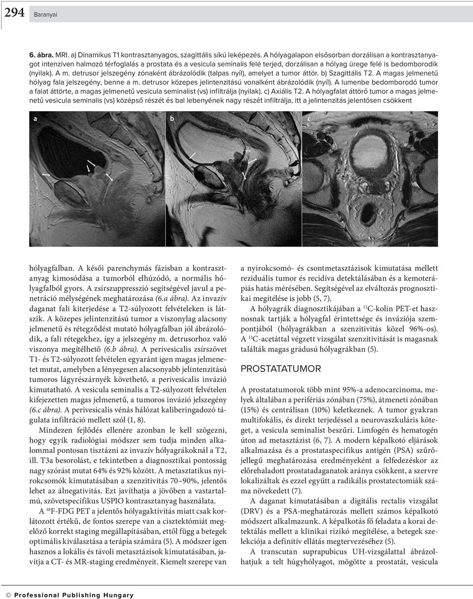 detrusor jelszegény zónként árázolódik (tlps nyíl), melyet tumor áttör. ) Szgittális T2. A mgs jelmenetű hólyg fl jelszegény, enne m. detrusor közepes jelintenzitású vonlként árázolódik (nyíl).