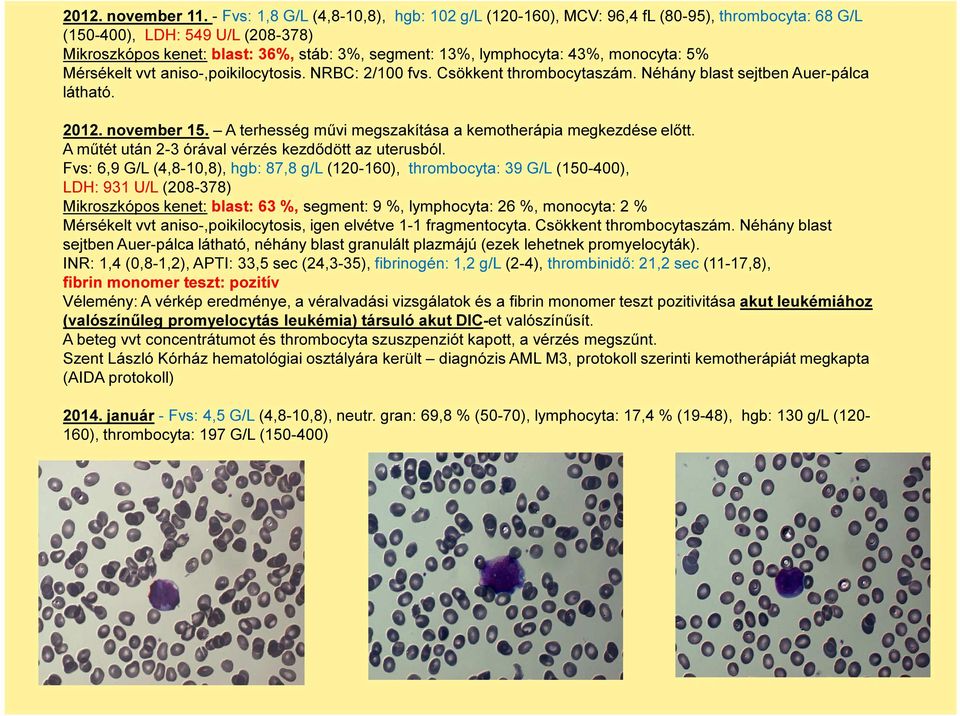 monocyta: 5% Mérsékelt vvt aniso-,poikilocytosis. NRBC: 2/100 fvs. Csökkent thrombocytaszám. Néhány blast sejtben Auer-pálca látható. 2012. november 15.