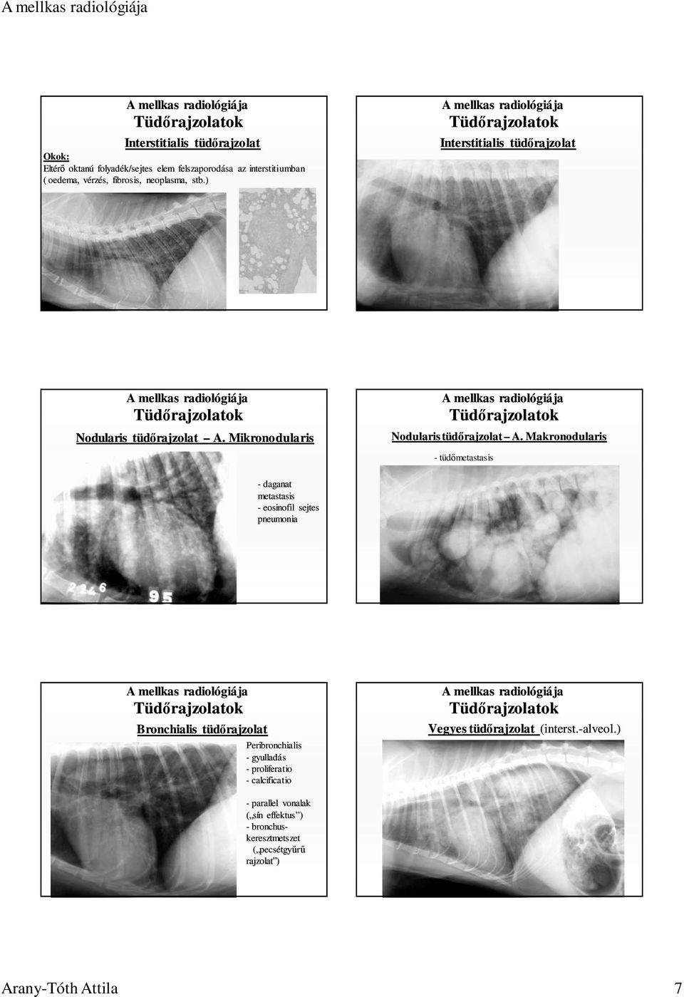 Makronodularis - tüdımetastasis - daganat metastasis - eosinofil sejtes pneumonia Bronchialis tüdırajzolat Peribronchialis - gyulladás -