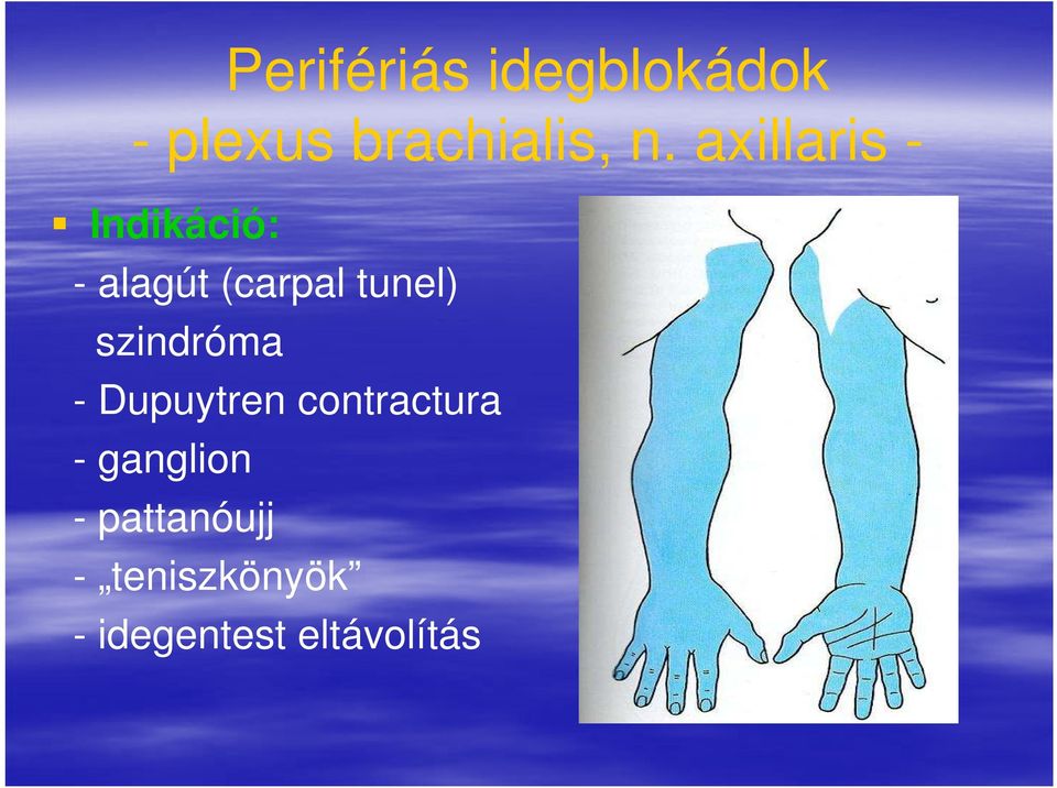 szindróma - Dupuytren contractura - ganglion -