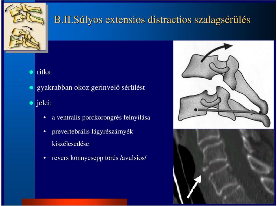 ventralis porckorongrés felnyilása prevertebrális