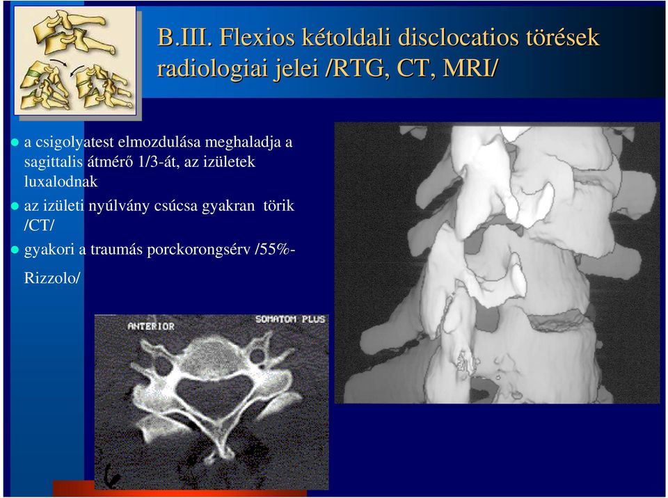 CT, MRI/ a csigolyatest elmozdulása meghaladja a sagittalis