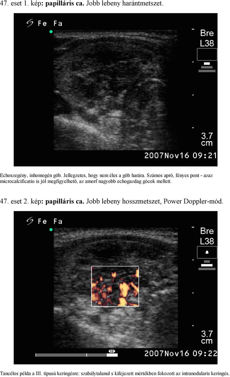 Számos apró, fényes pont - azaz microcalcificatio is jól megfigyelhetõ, az amorf nagyobb echogazdag gócok