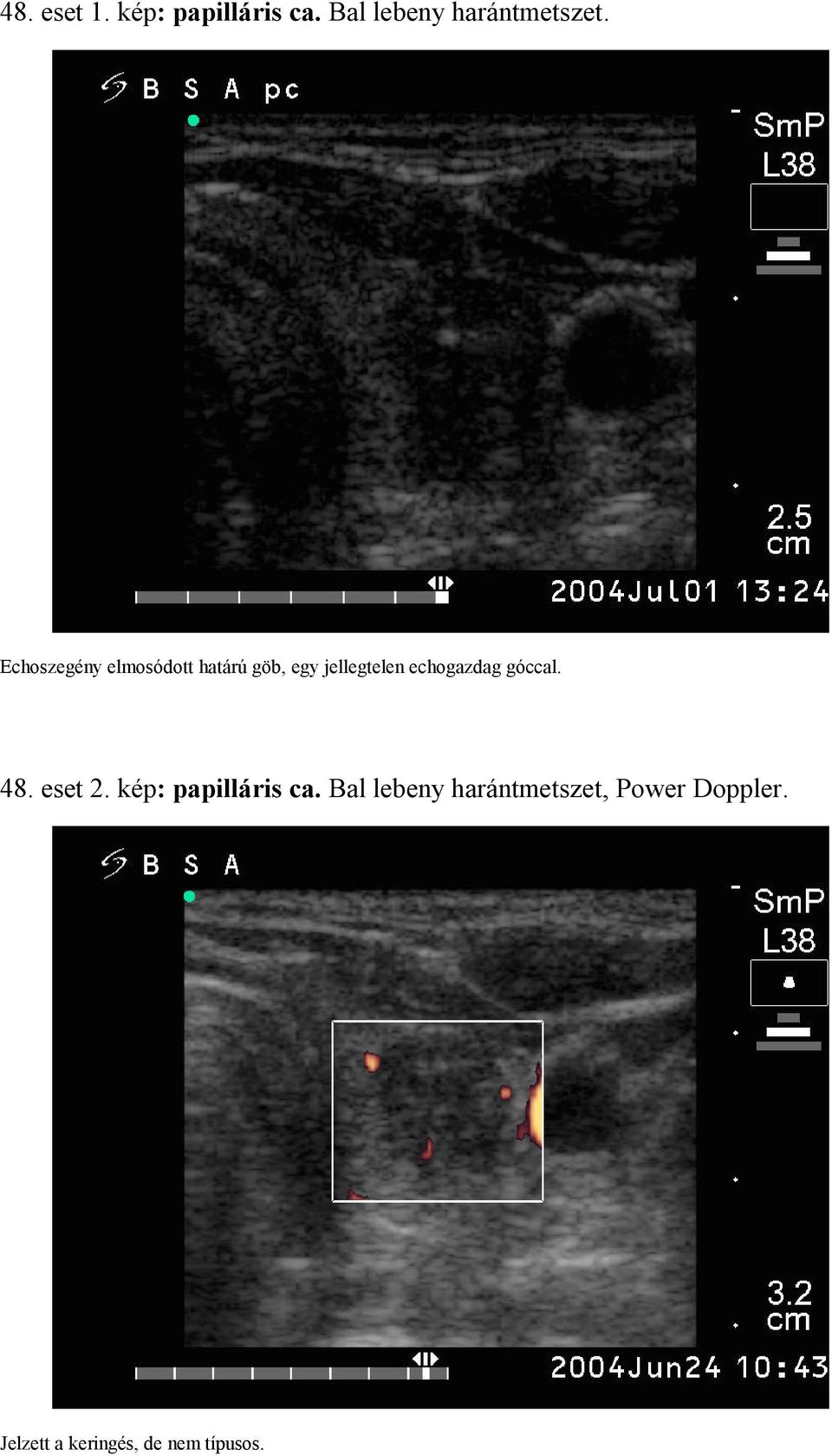 echogazdag góccal. 48. eset 2. kép: papilláris ca.