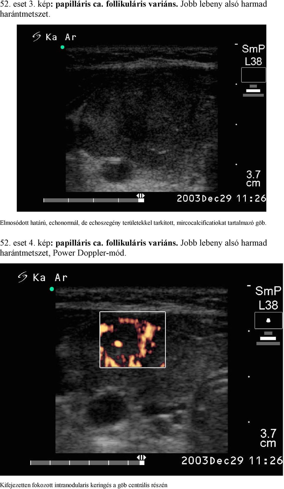 tartalmazó göb. 52. eset 4. kép: papilláris ca. follikuláris variáns.