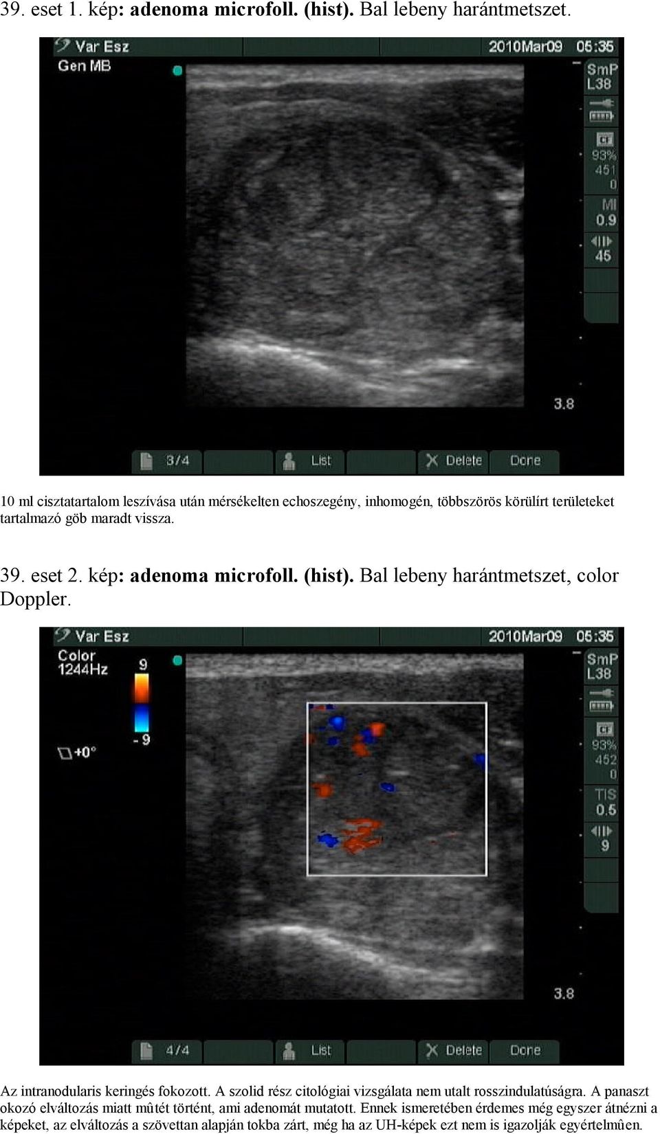 kép: adenoma microfoll. (hist). Bal lebeny harántmetszet, color Doppler. Az intranodularis keringés fokozott.