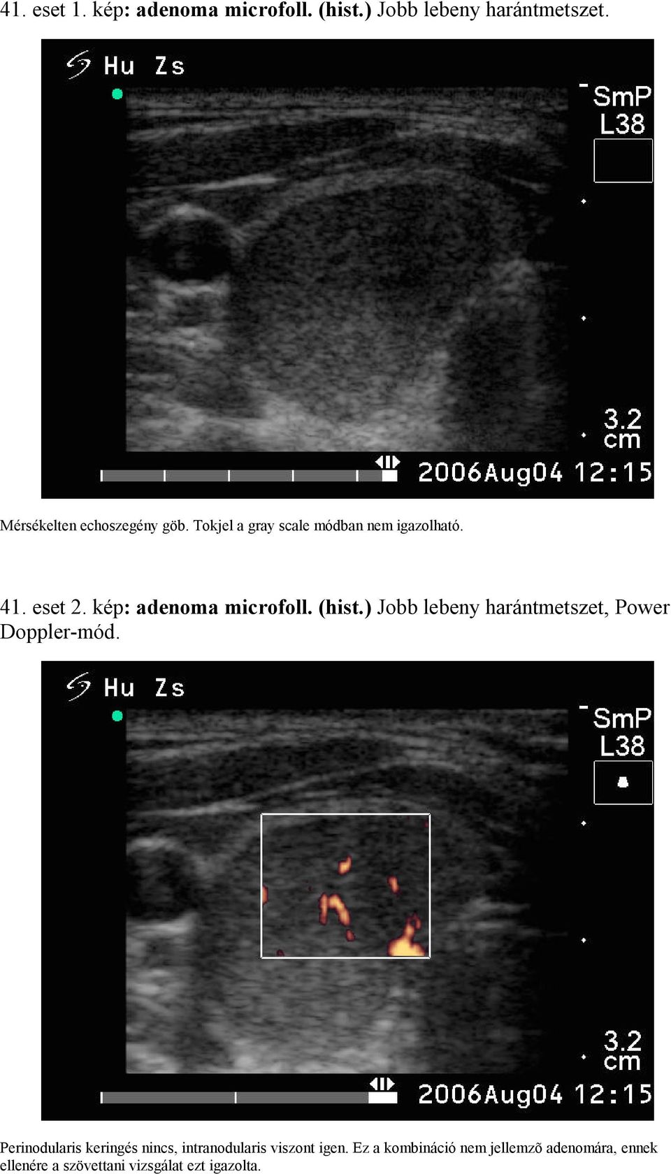 kép: adenoma microfoll. (hist.) Jobb lebeny harántmetszet, Power Doppler-mód.