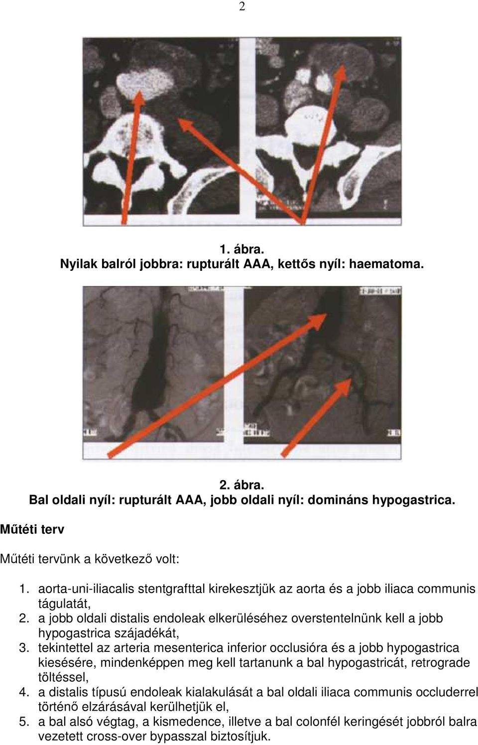 a jobb oldali distalis endoleak elkerüléséhez overstentelnünk kell a jobb hypogastrica szájadékát, 3.