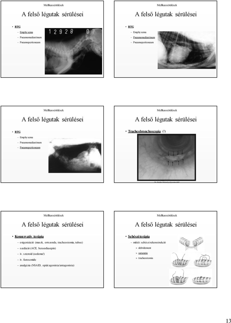 Psáder Roland gyűjteményéből A felső légutak sérülései Konzervatív terápia oxigenizáció (maszk, orrszonda, tracheostomia, tubus) szedáció (ACE, benzodiazepin)