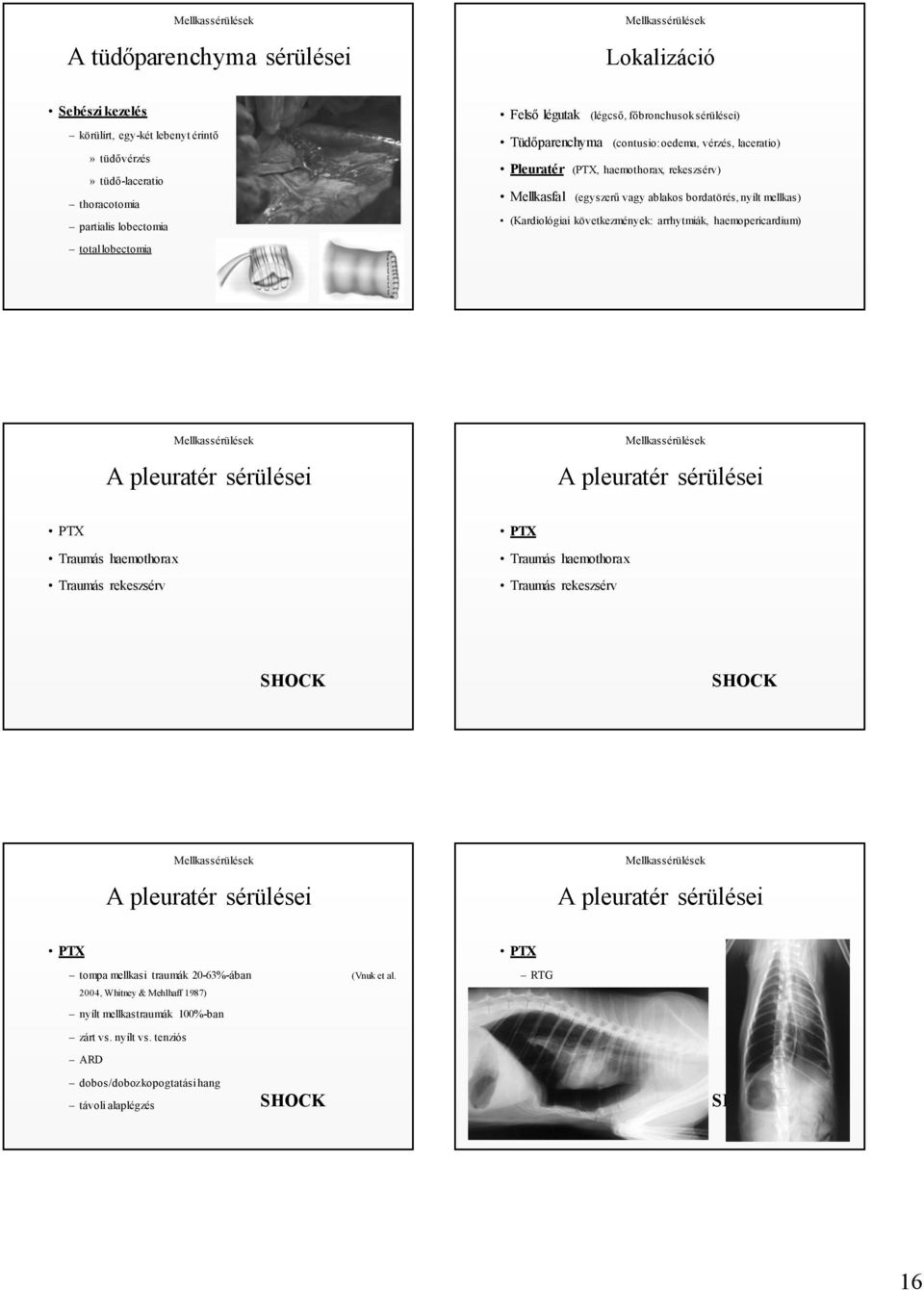 következmények: arrhytmiák, haemopericardium) A pleuratér sérülései A pleuratér sérülései PTX Traumás haemothorax Traumás rekeszsérv PTX Traumás haemothorax Traumás rekeszsérv A pleuratér sérülései A