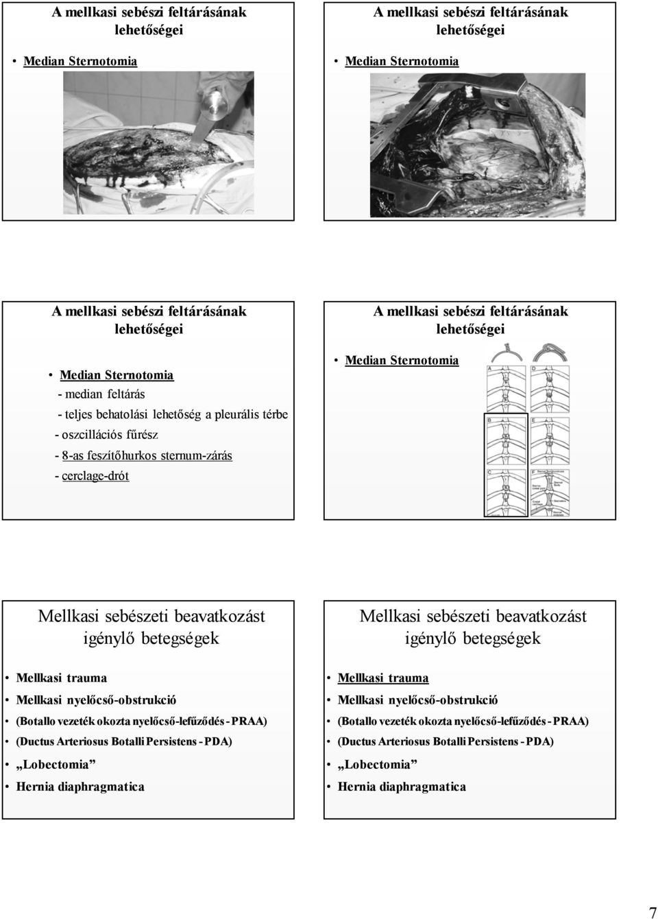 Mellkasi sebészeti beavatkozást igénylő betegségek Mellkasi trauma Mellkasi nyelőcső-obstrukció (Botallo vezeték okozta nyelőcső-lefűződés - PRAA) (Ductus Arteriosus Botalli Persistens - PDA)