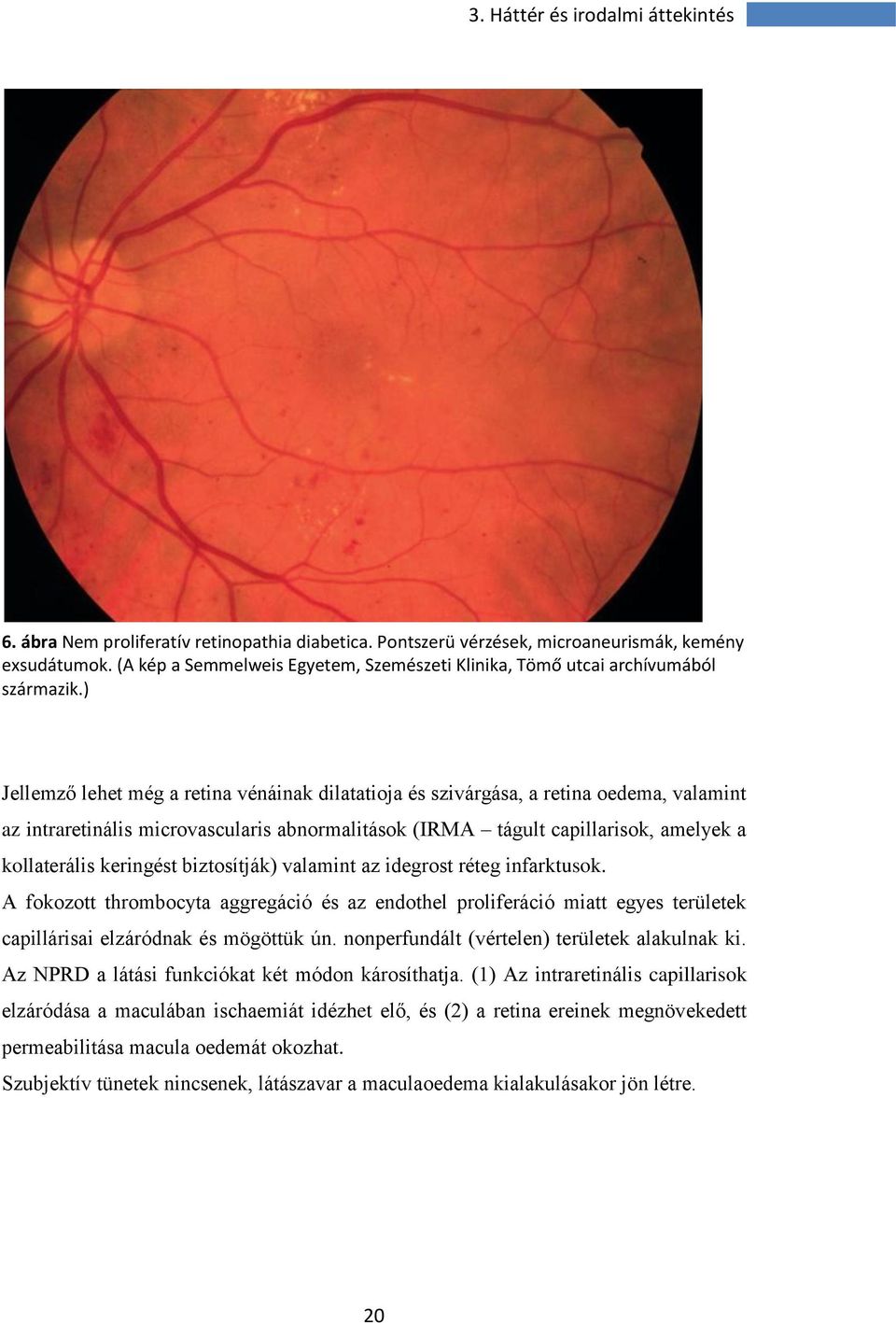 ) Jellemző lehet még a retina vénáinak dilatatioja és szivárgása, a retina oedema, valamint az intraretinális microvascularis abnormalitások (IRMA tágult capillarisok, amelyek a kollaterális