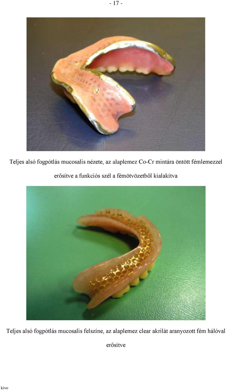 fémötvözetből kialakítva Teljes alsó fogpótlás mucosalis