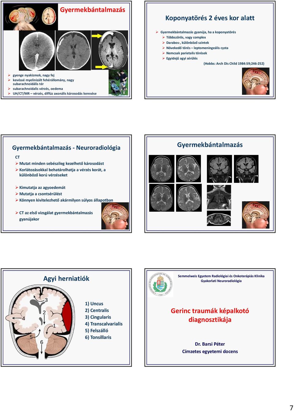 oedema UH/CT/MR vérzés, diffúz axonális károsodás keresése Gyermekbántalmazás Neuroradiológia CT Mutat minden sebészileg kezelhető károsodást Korlátozásokkal behatárolhatja a vérzés korát, a