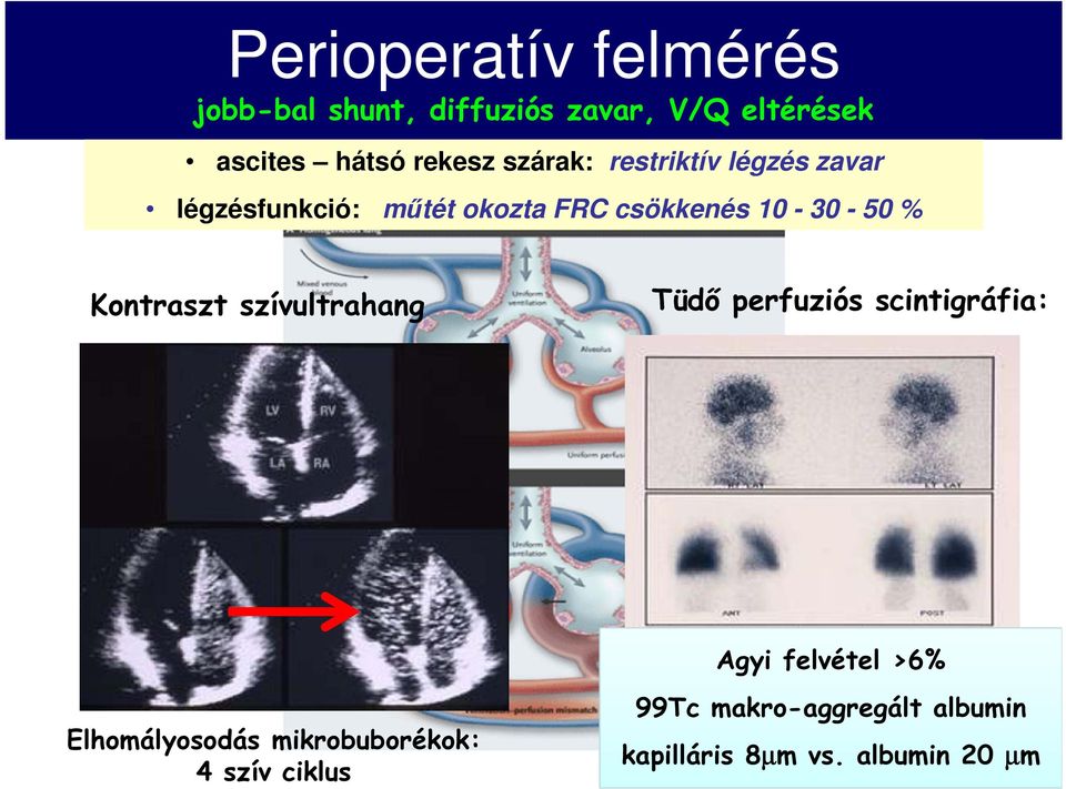 50 % Kontraszt szívultrahang Tüdő perfuziós scintigráfia: Agyi felvétel >6%
