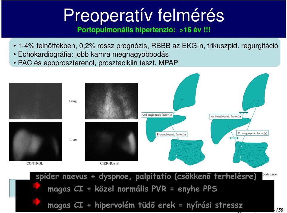 dyspnoe, palpitatio (csökkenő terhelésre) makrofágjelölt szcintigráfia magas CI + közel normális PVR = enyhe PPS by pass the