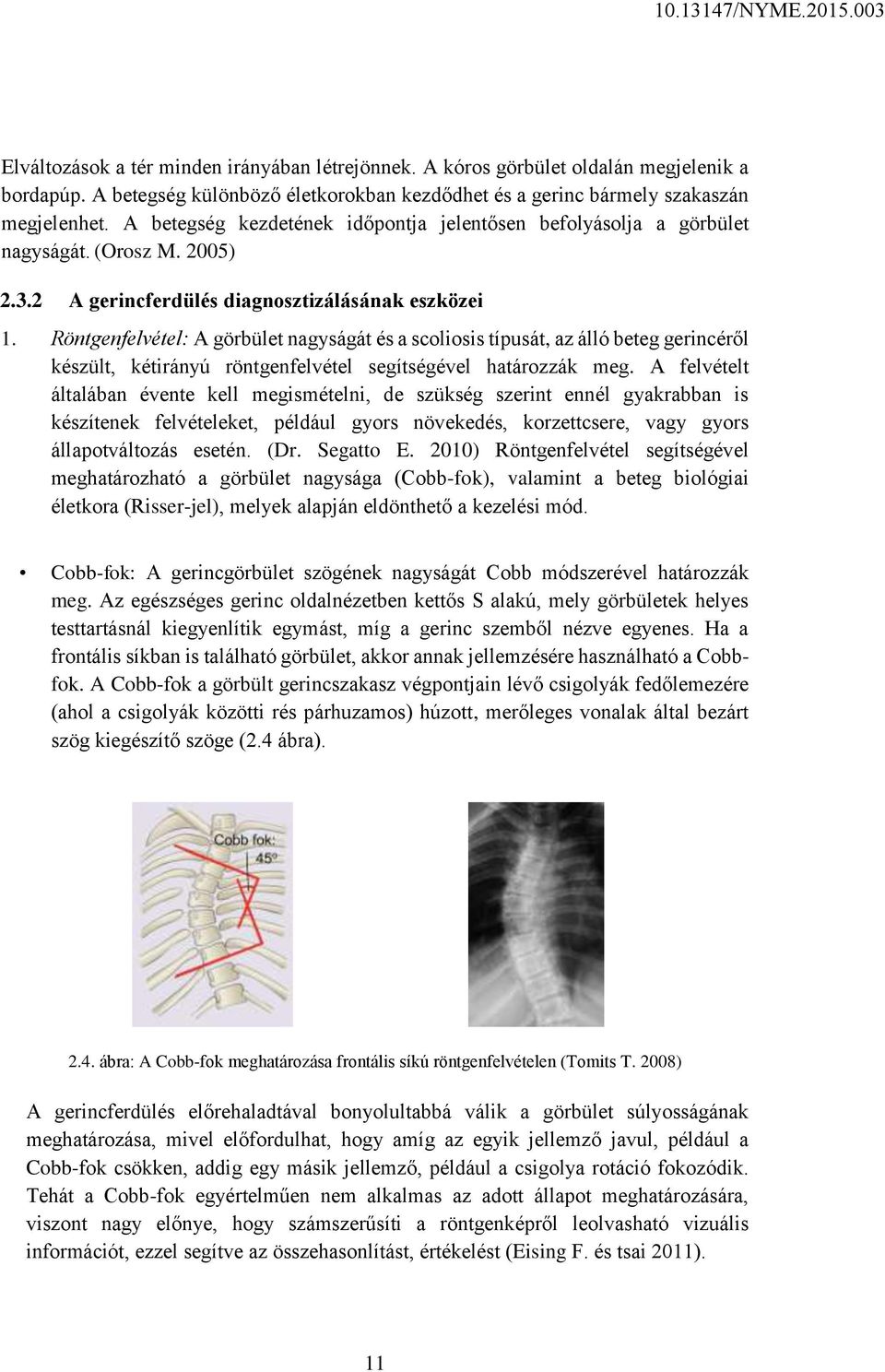 Röntgenfelvétel: A görbület nagyságát és a scoliosis típusát, az álló beteg gerincéről készült, kétirányú röntgenfelvétel segítségével határozzák meg.