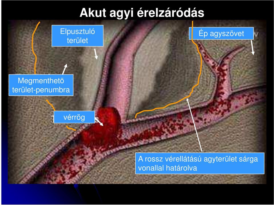 terület-penumbra vérrög A rossz