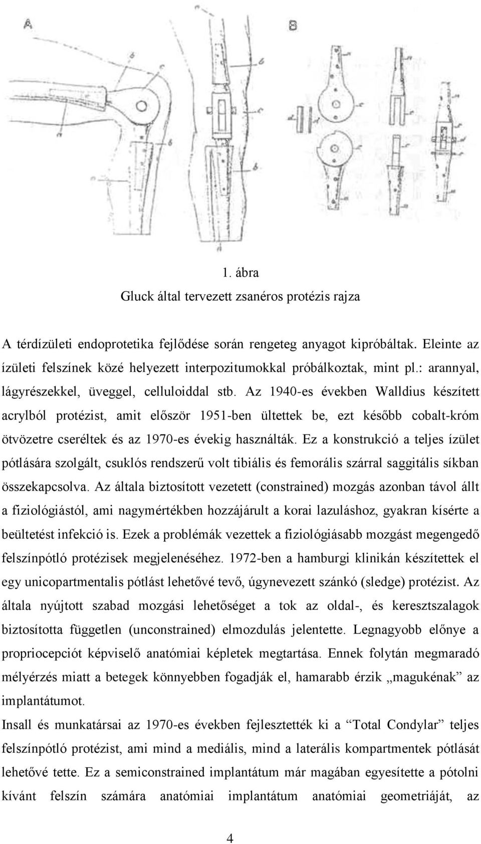 Az 1940-es években Walldius készített acrylból protézist, amit először 1951-ben ültettek be, ezt később cobalt-króm ötvözetre cseréltek és az 1970-es évekig használták.