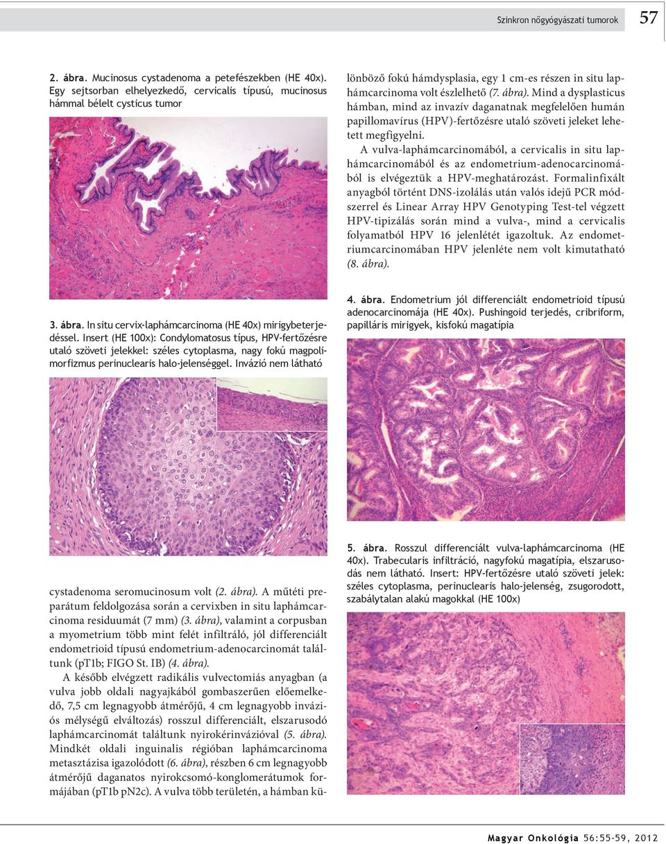 A műtéti preparátum feldolgozása során a cervixben in situ laphám carci noma residuumát (7 mm) (3.