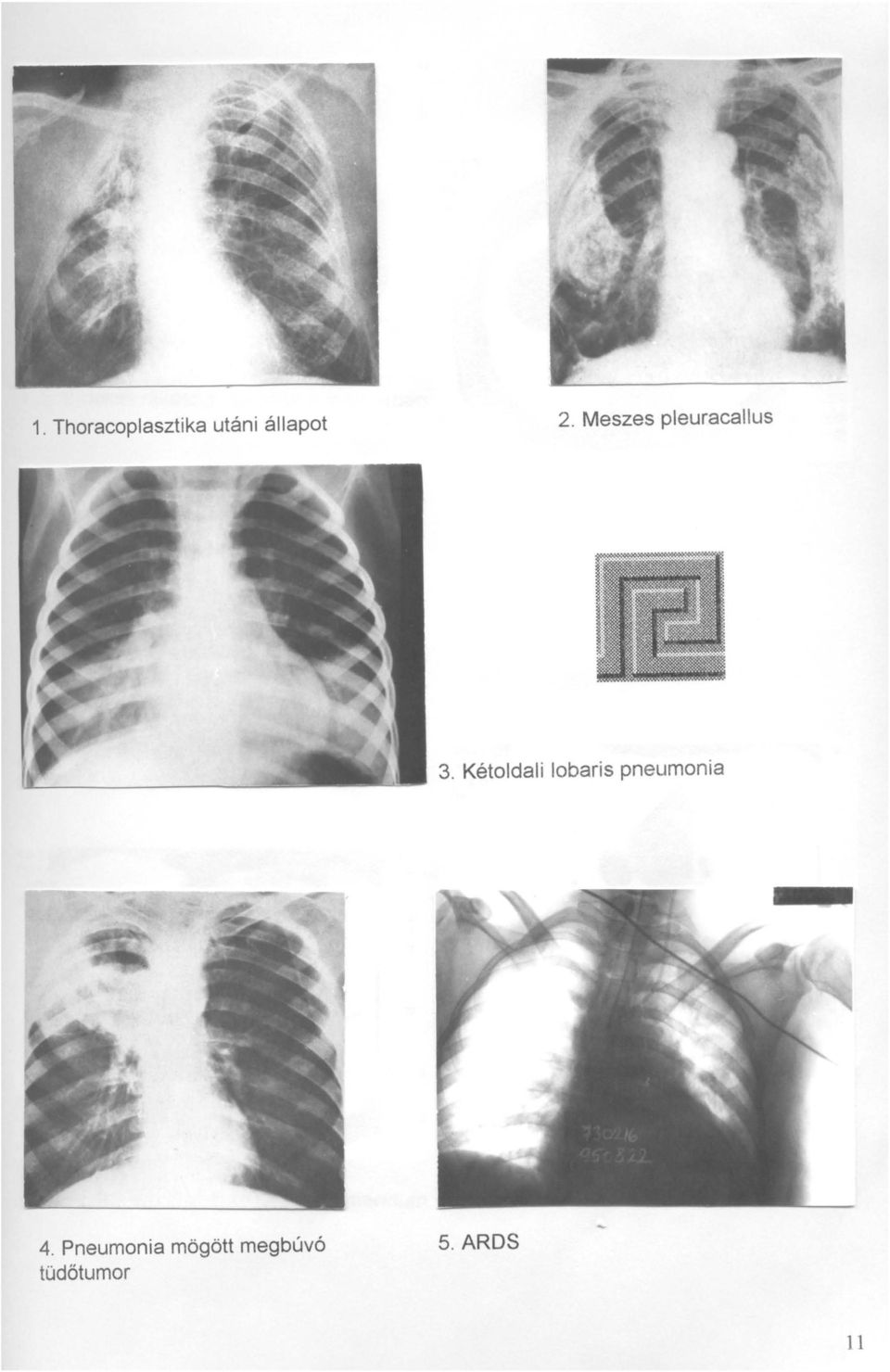 Kétoldali lobaris pneumonia 4.