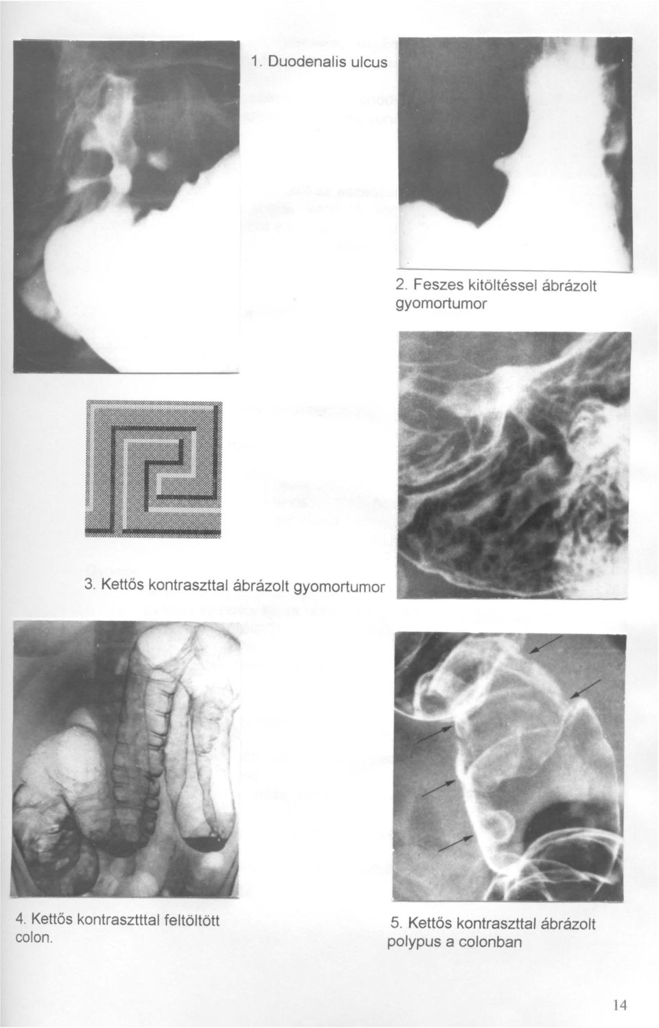 Kettős kontraszttal ábrázolt gyomortumor 4.