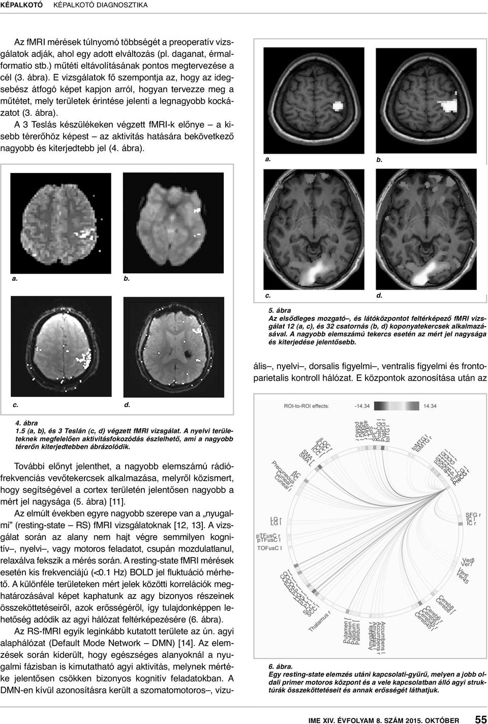 A 3 Teslás készülékeken végzett fmri-k előnye a kisebb térerőhöz képest az aktivitás hatására bekövetkező nagyobb és kiterjedtebb jel (4. ábra). c. d. 5.