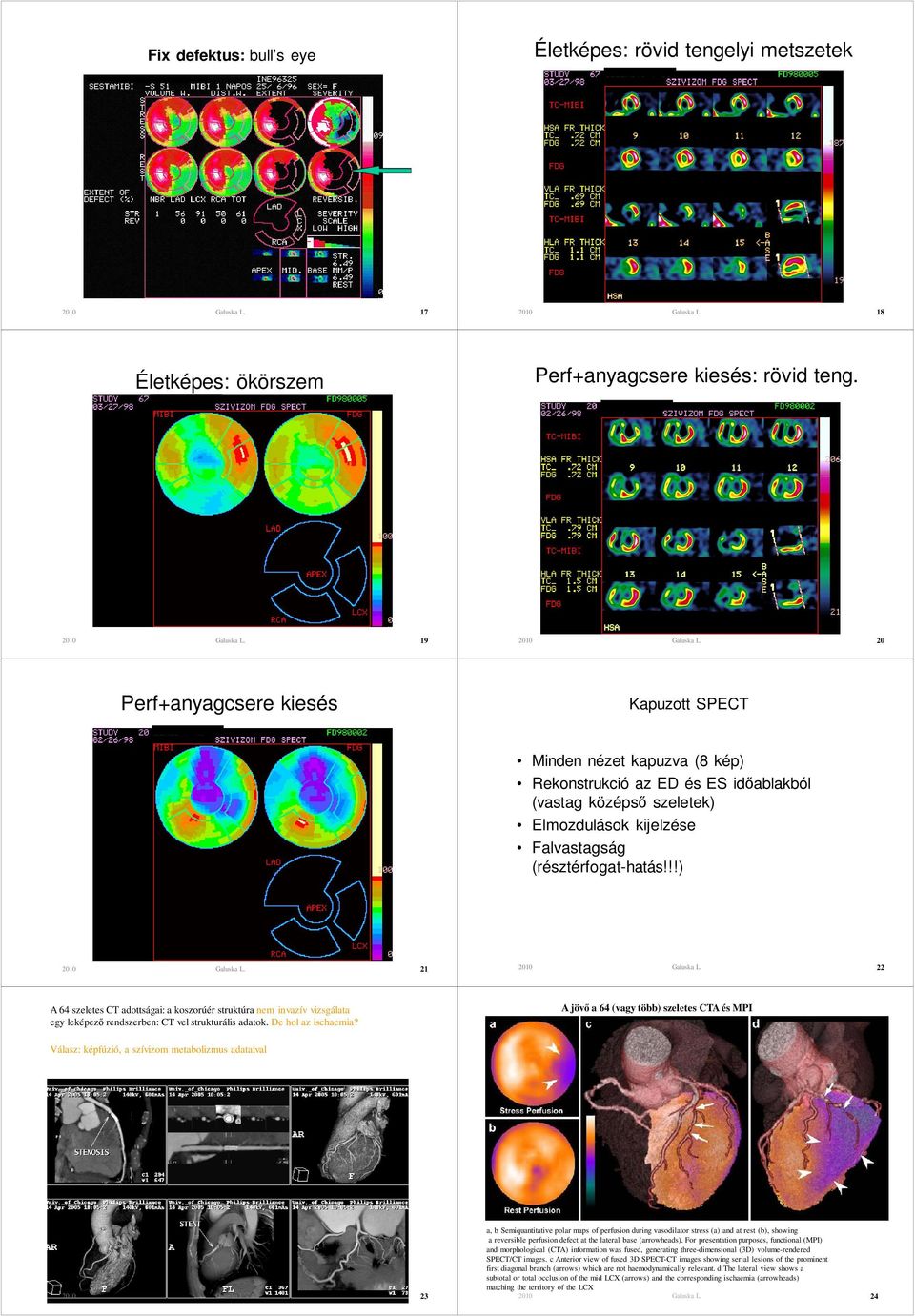 !!) 21 22 A 64 szeletes CT adottságai: a koszorúér struktúra nem invazív vizsgálata egy leképezı rendszerben: CT vel strukturális adatok. De hol az ischaemia?