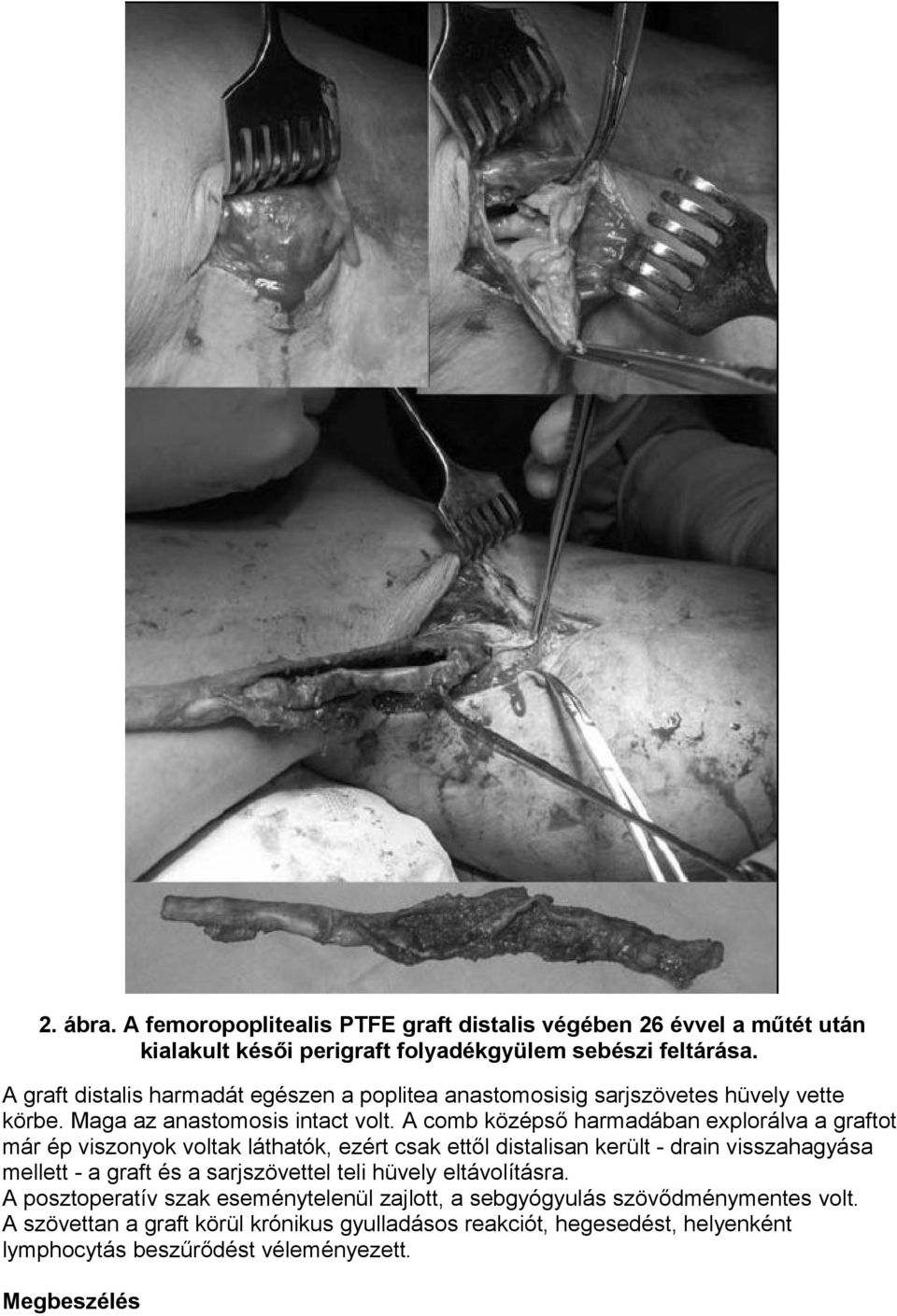 A comb középső harmadában explorálva a graftot már ép viszonyok voltak láthatók, ezért csak ettől distalisan került - drain visszahagyása mellett - a graft és a