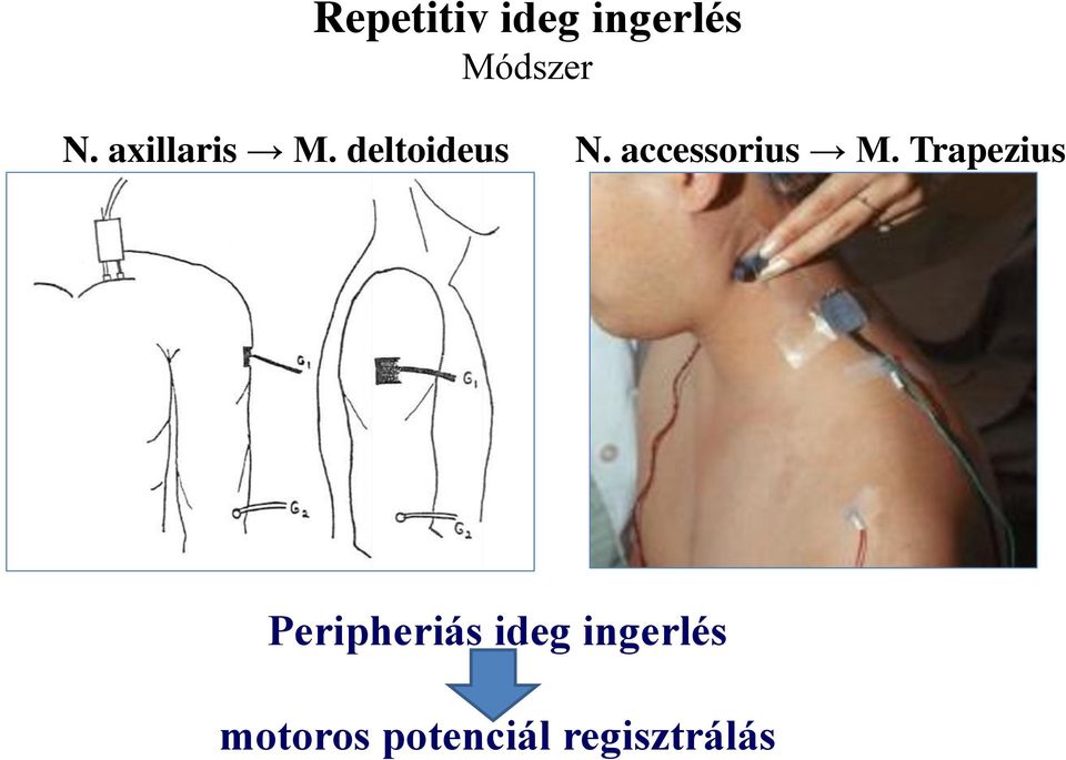 accessorius M.