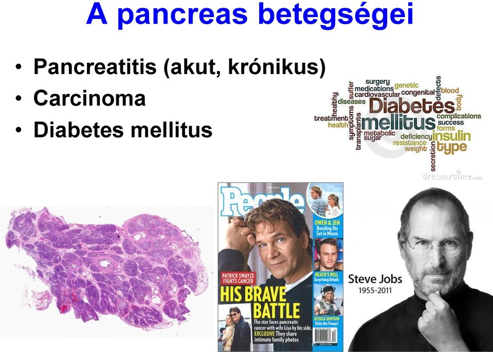 Pancreatitis (akut,