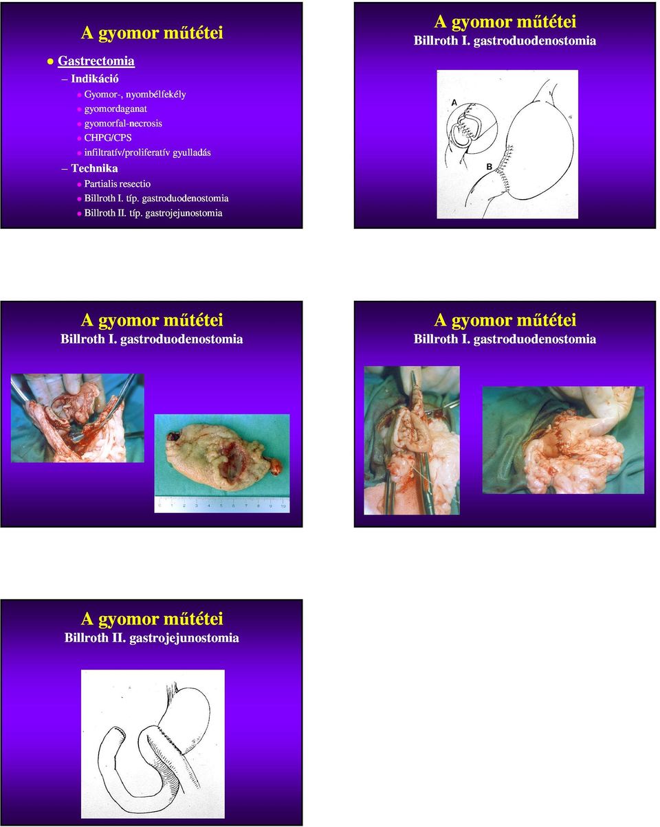 gastroduodenostomia Billroth II. típ. gastrojejunostomia Billroth I.