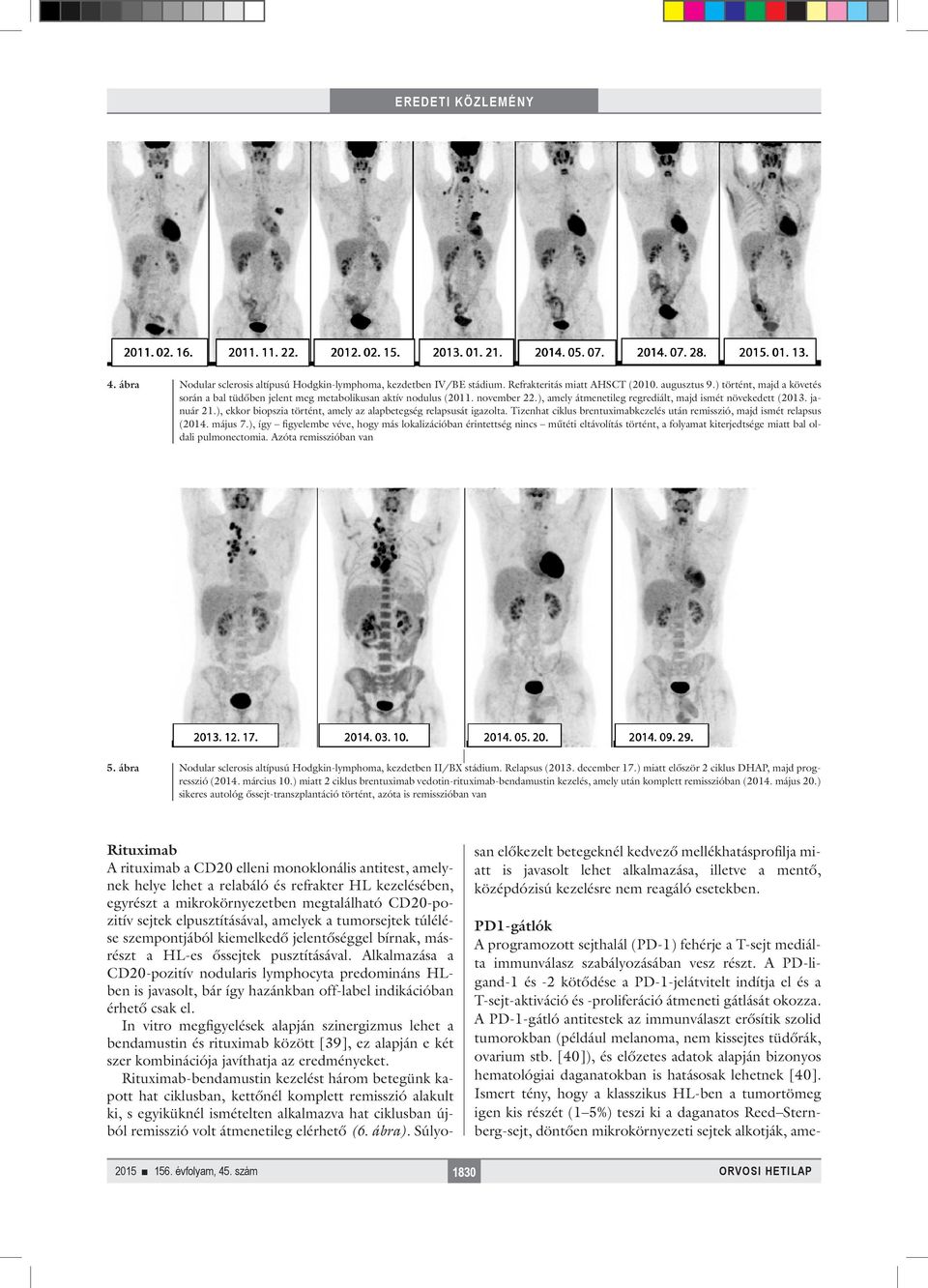 ), ekkor biopszia történt, amely az alapbetegség relapsusát igazolta. Tizenhat ciklus brentuximabkezelés után remisszió, majd ismét relapsus (2014. május 7.