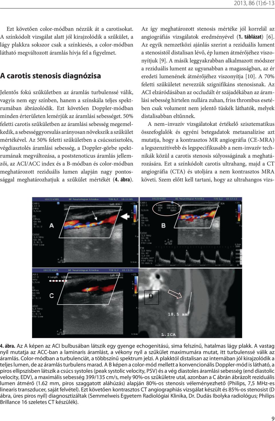 A carotis stenosis diagnózisa Jelentős fokú szűkületben az áramlás turbulenssé válik, vagyis nem egy színben, hanem a színskála teljes spektrumában ábrázolódik.