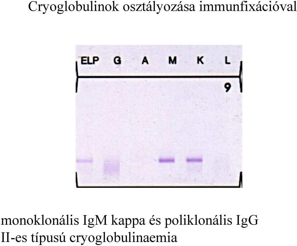 IgM kappa és poliklonális IgG