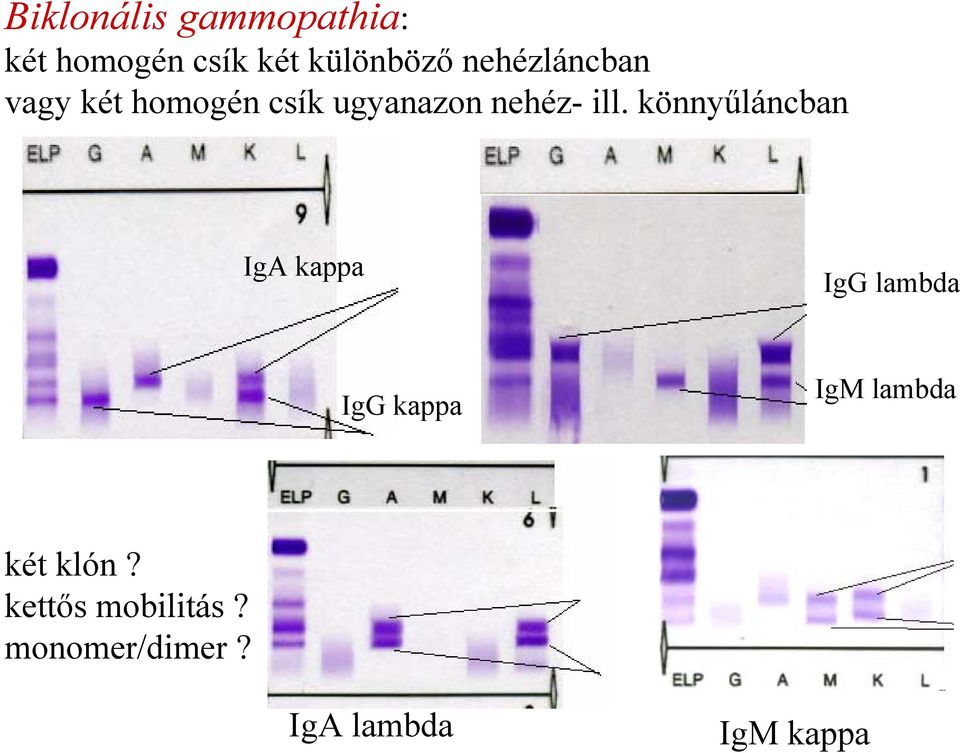 könnyűláncban IgA kappa IgG lambda IgG kappa IgM lambda