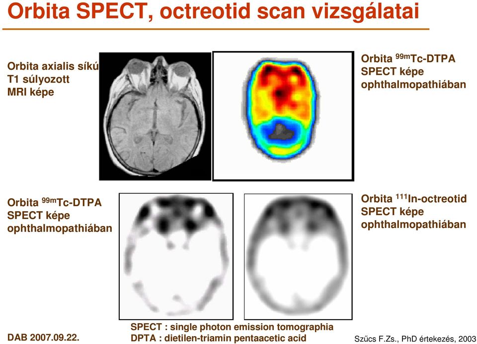 ophthalmopathiában Orbita 111 In-octreotid SPECT képe ophthalmopathiában SPECT : single