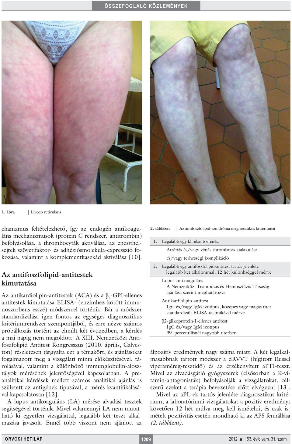 Az antifoszfolipid-antitestek kimutatása Az antikardiolipin-antitestek (ACA) és a β 2 -GPI-ellenes antitestek kimutatása ELISA- (enzimhez kötött immunoszorbens esszé) módszerrel történik.